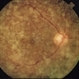 Asteroid Hyalosis Asteroid Hyalosis